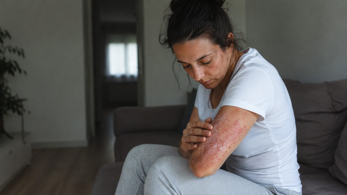 What can I claim if I have psoriasis?