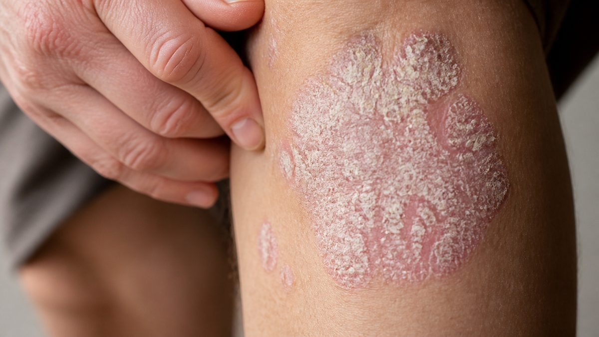 What organ does psoriasis affect?