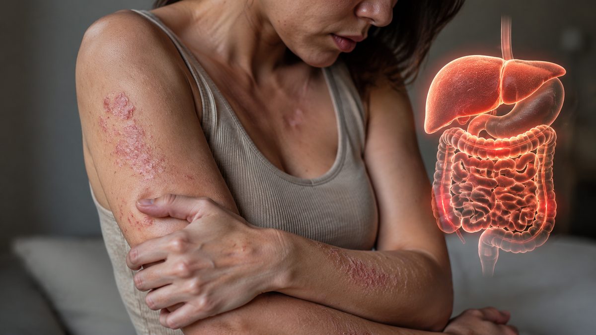 What organ is linked to psoriasis?