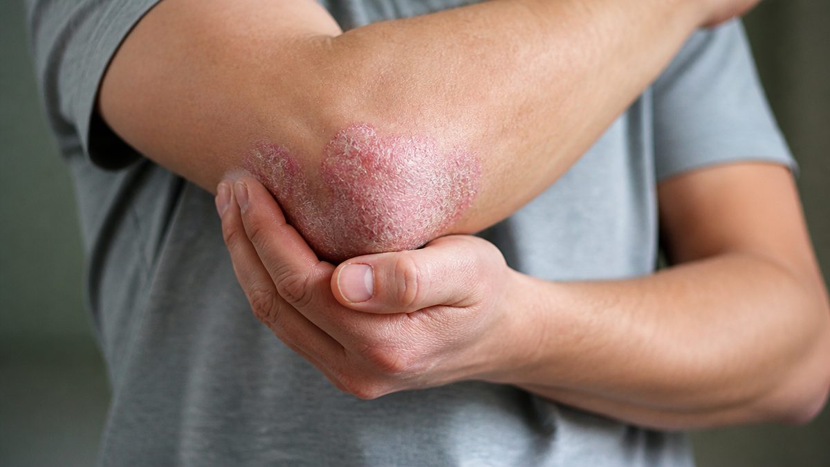 What vitamin am I lacking if I have psoriasis?